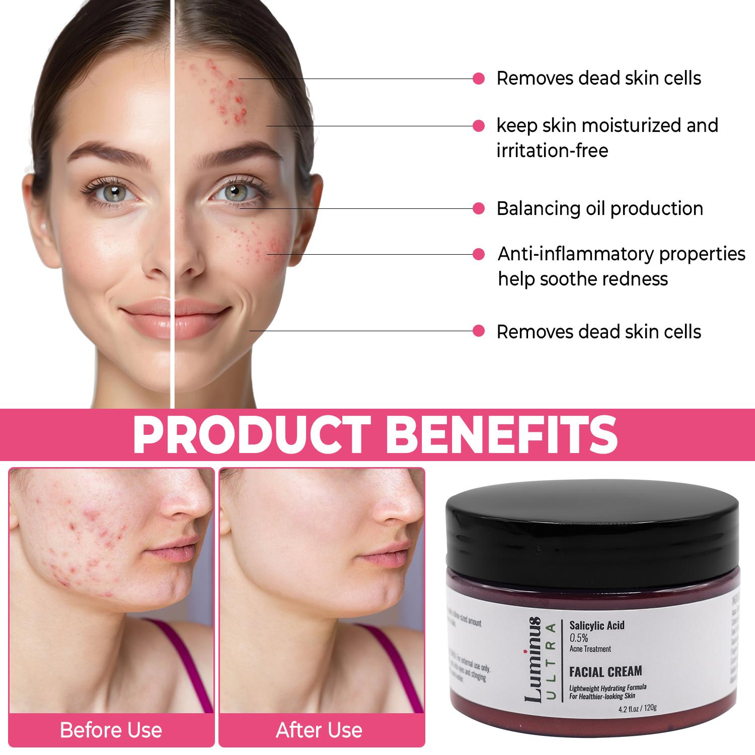 0.5% Salicylic Acne Cream-1