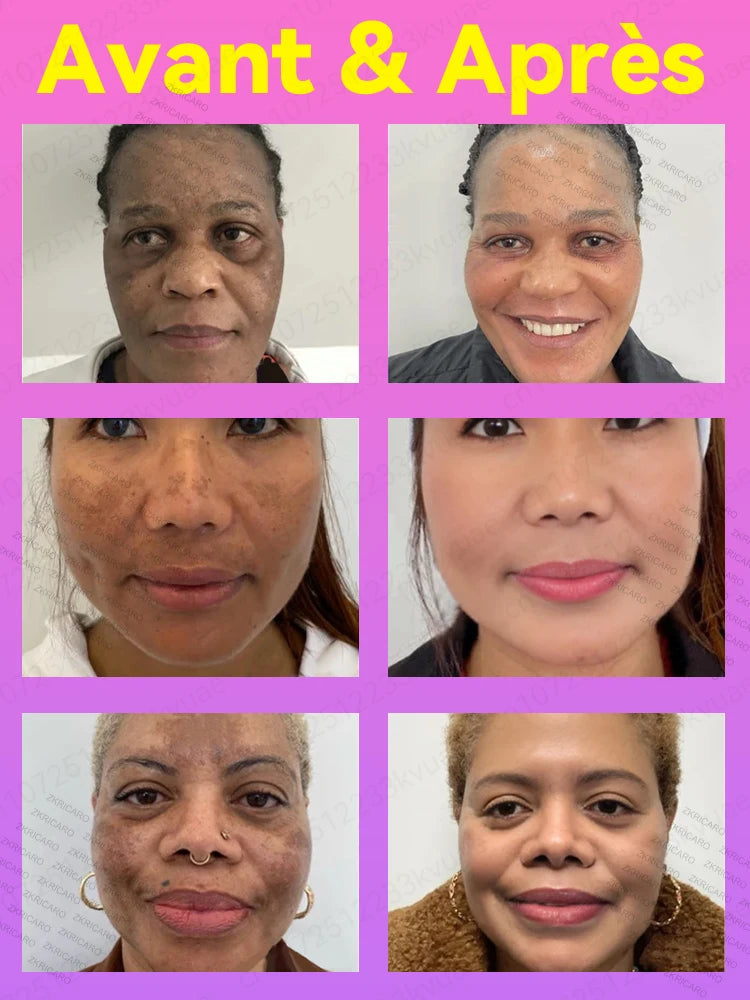 Éliminez le mélasma et les taches brunes sans douleur Hive JFA & TA Store