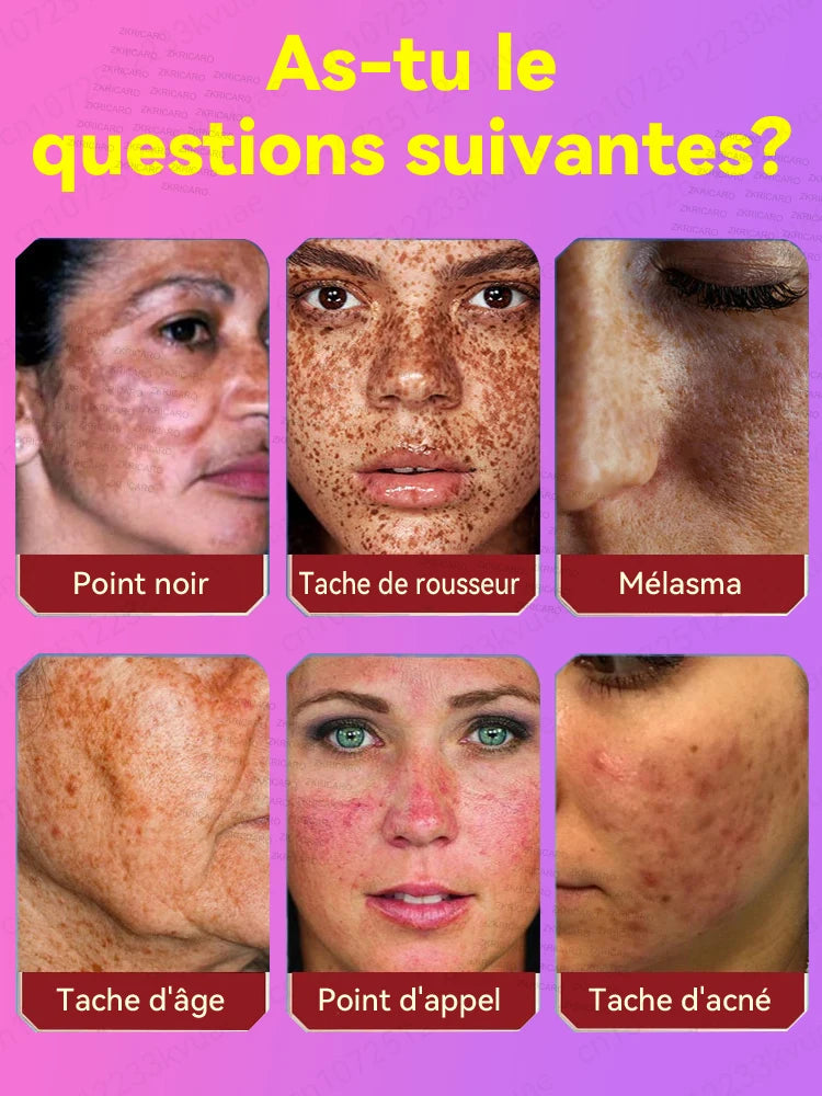 Éliminez le mélasma et les taches brunes sans douleur Hive JFA & TA Store