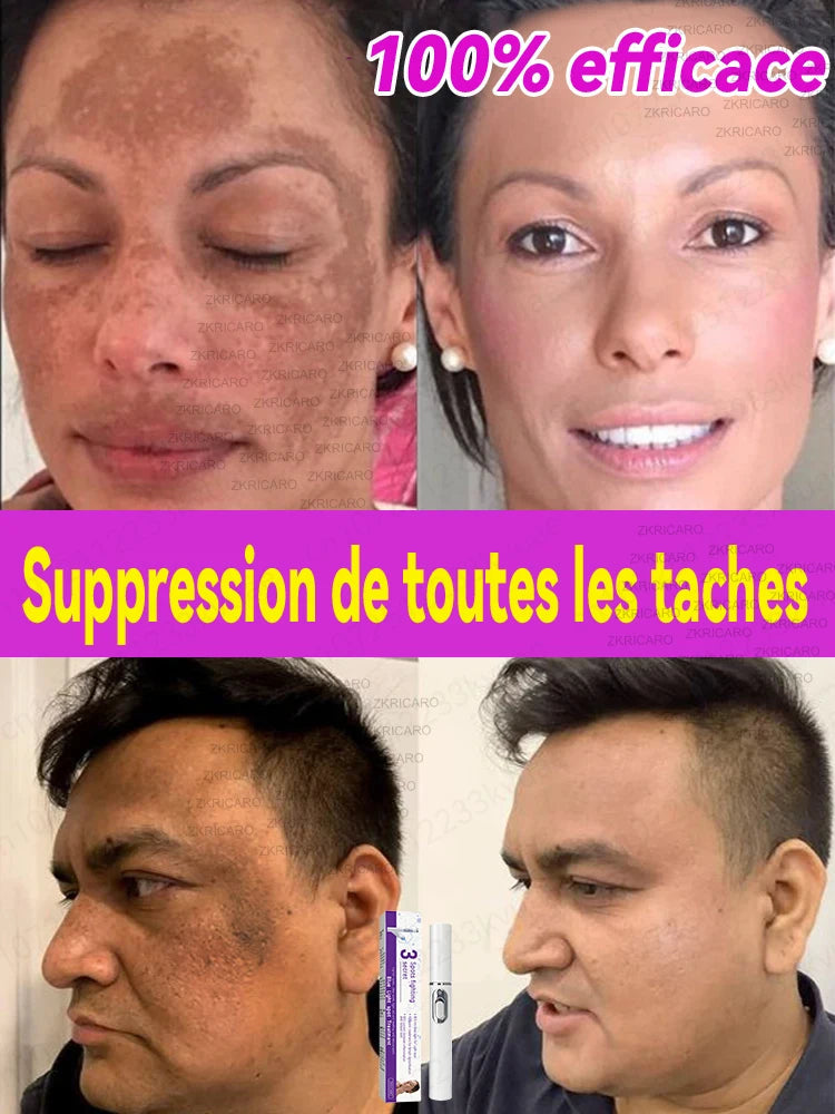 Éliminez le mélasma et les taches brunes sans douleur Hive JFA & TA Store